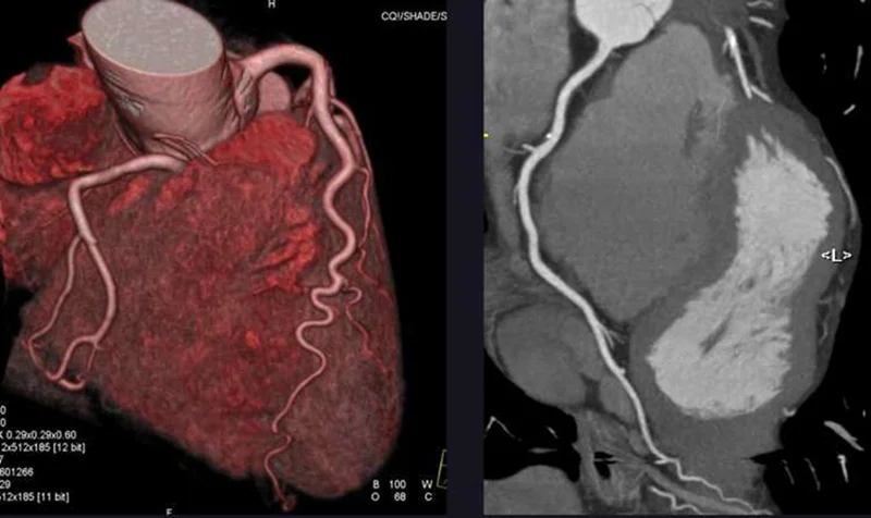 CT or Invasive Coronary Angiography in Stable Chest Pain